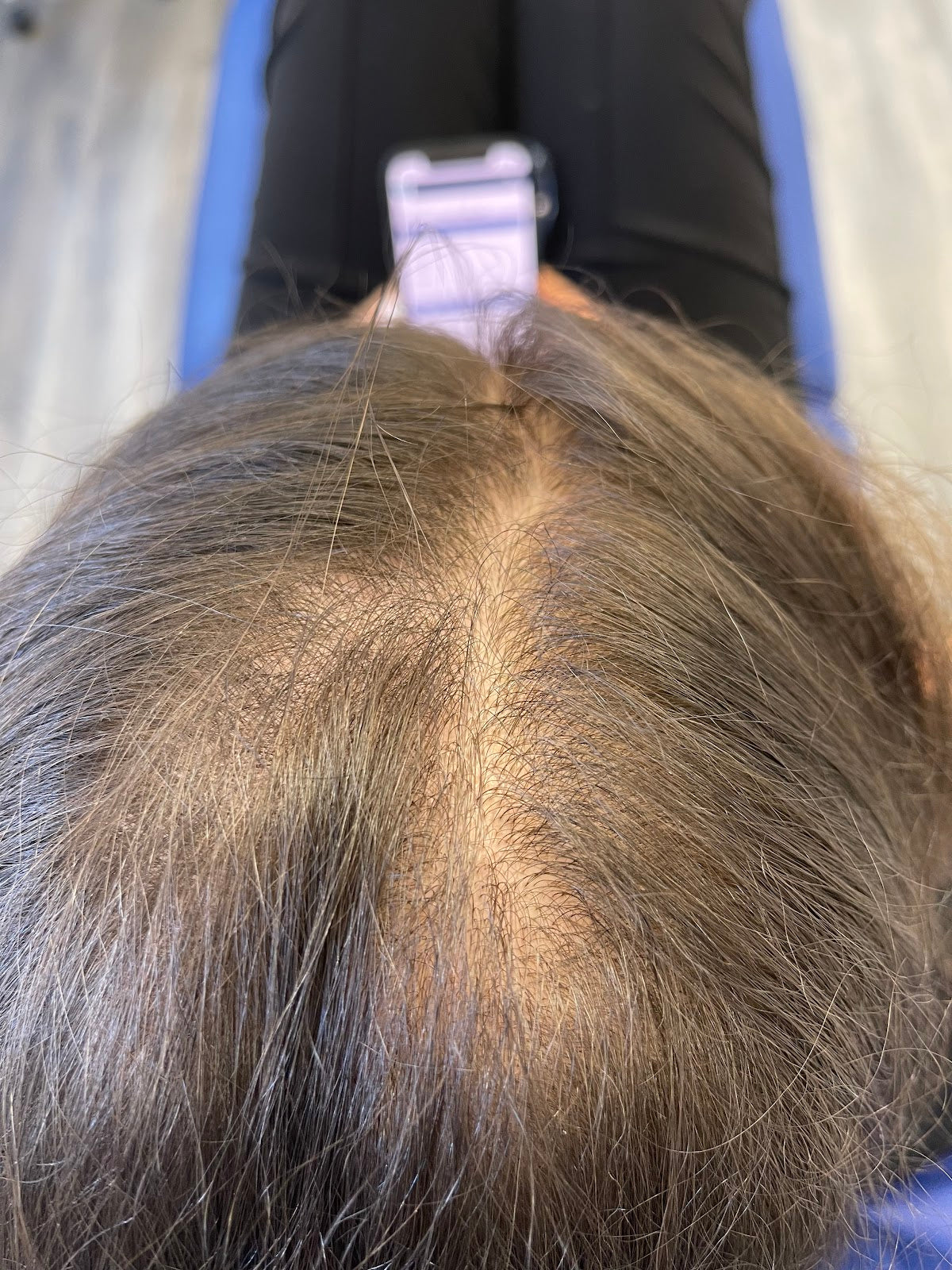 The Hair Loss Clinic | PRP + PRF Injections £195* | Exosomes | Steroid Alopecia Treatment — photo 4