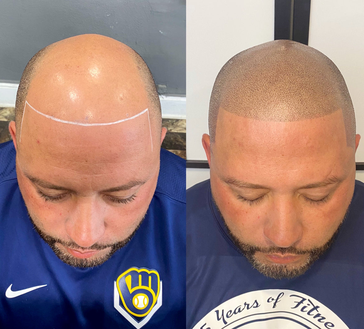 SkalpX  Micropigmentation | Hair Transplant | Milwaukee, WI