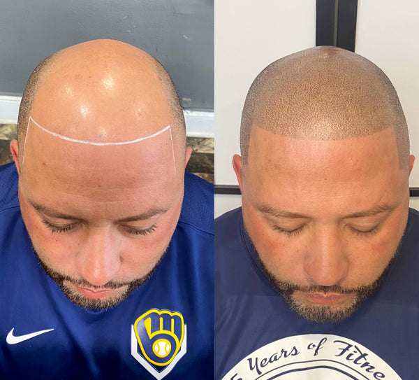SkalpX  Micropigmentation | Hair Transplant | Milwaukee, WI