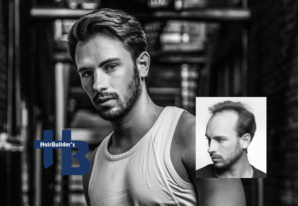 HairBuilders | Hair Transplant | Williston, VT