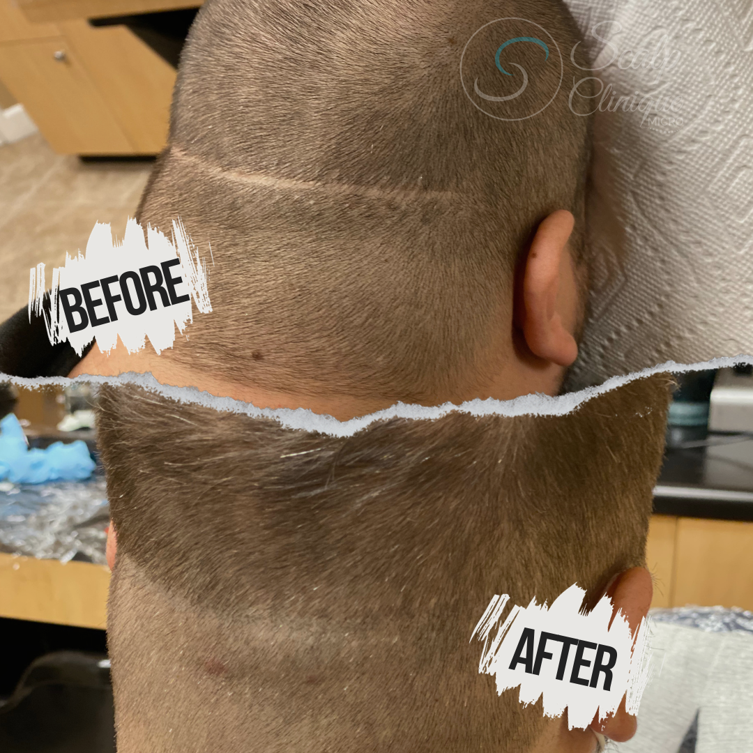 Scalp Clinique Micro | Hair Transplant | Metairie, LA