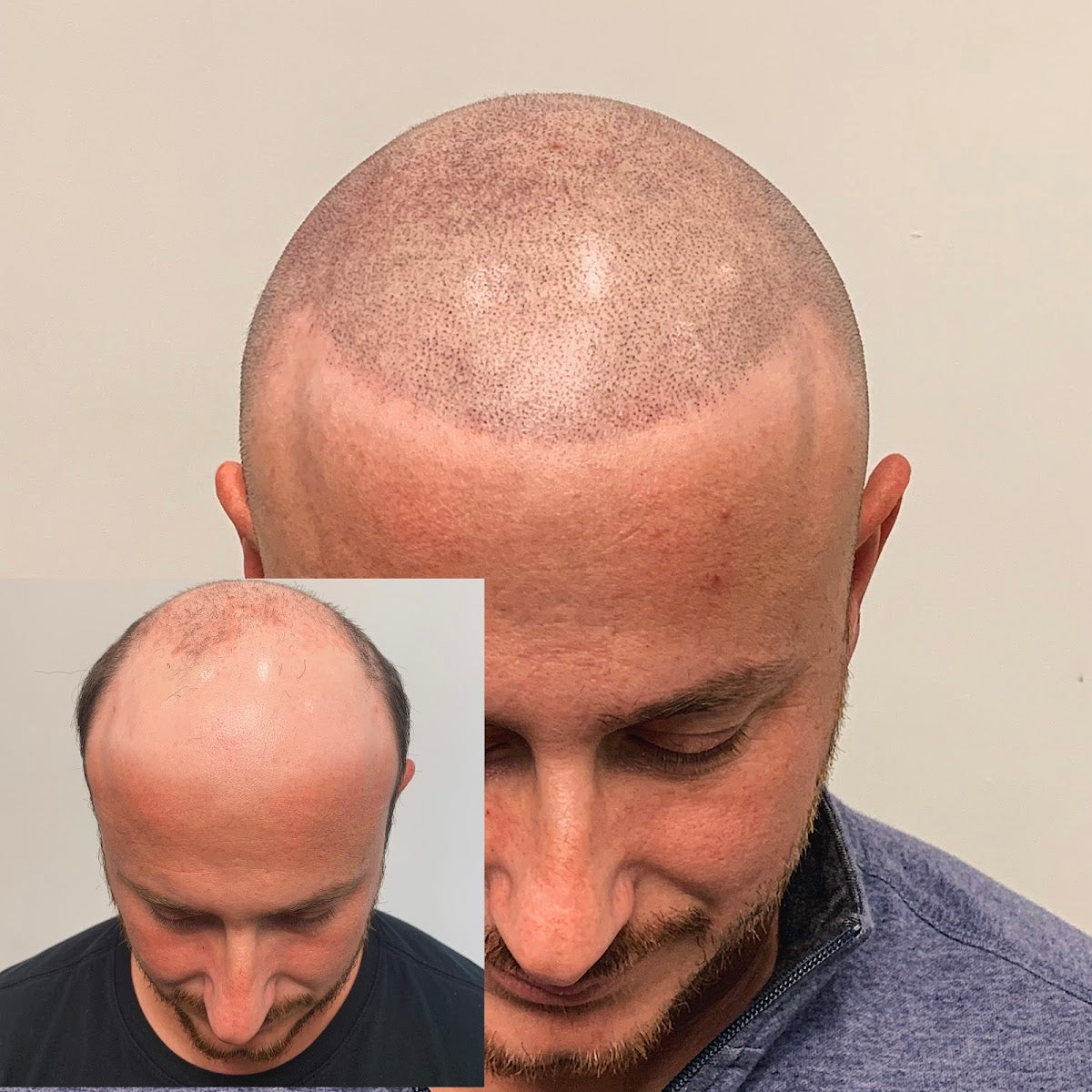 Ink & Ashberry formerly SMP | Hair Transplant | Camas, OR
