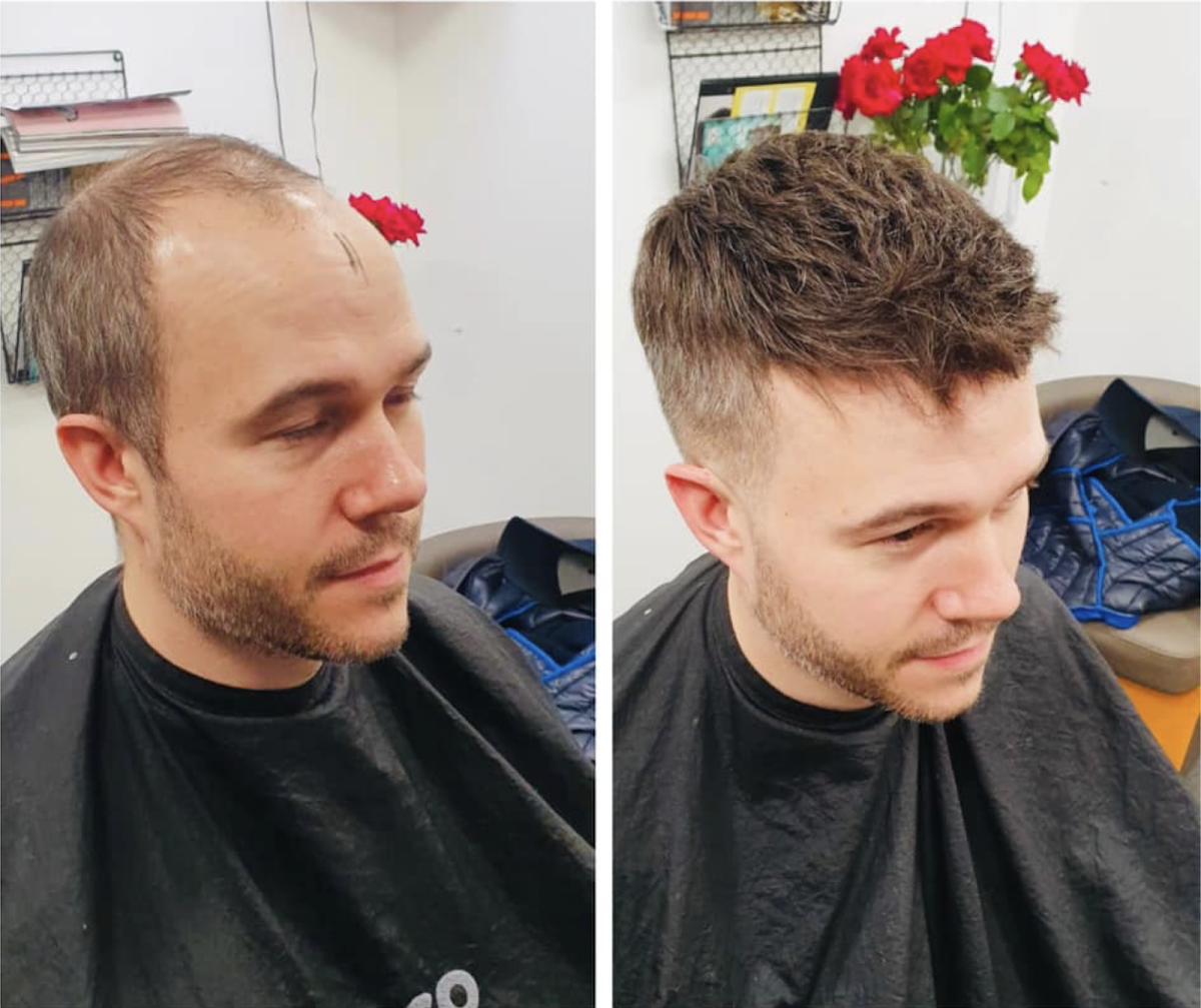 MensHair2Go — Hair Transplant Clinic in London