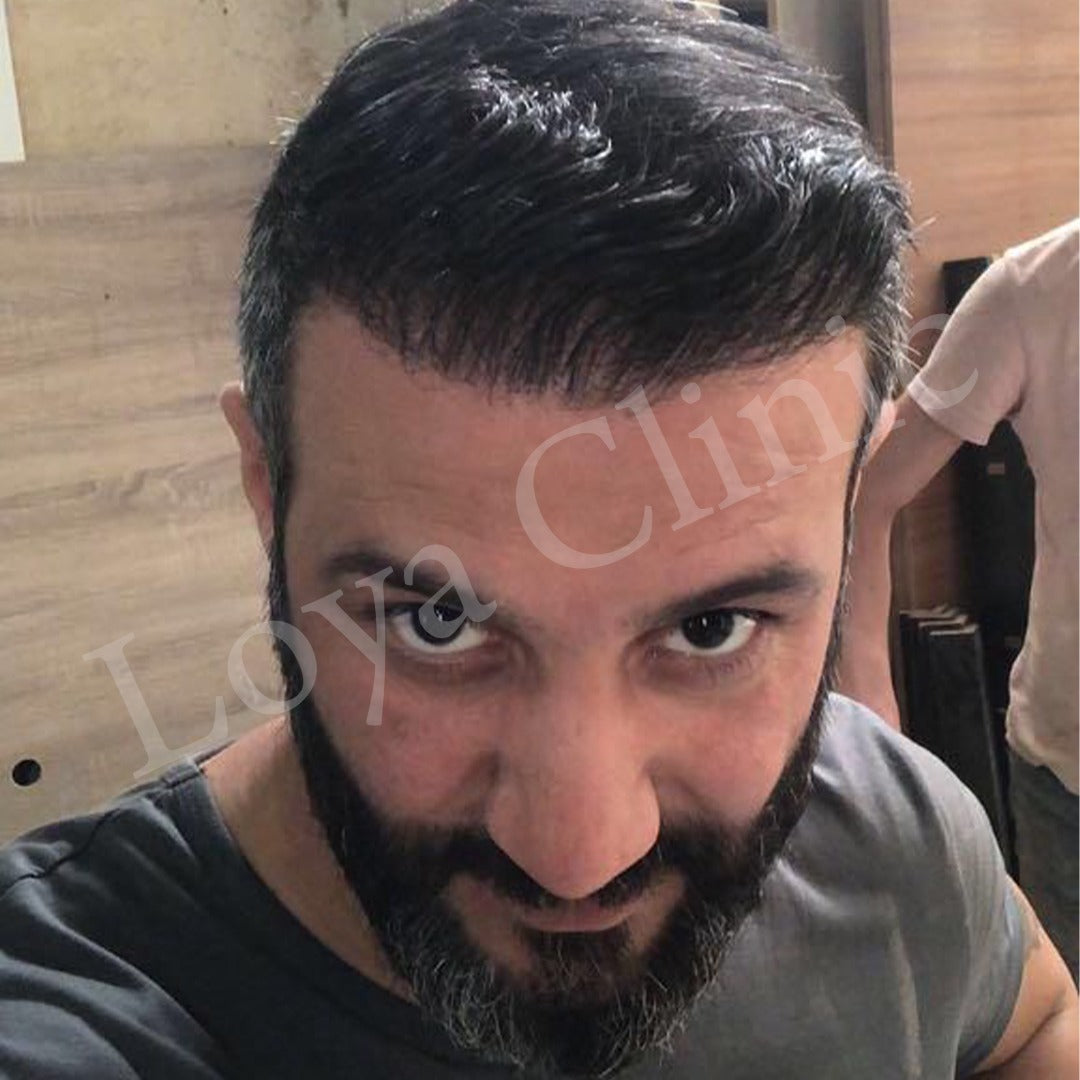 İzmir Saç Ekim Merkezi | Loya Clinic | Fue saç ekimi | İzmir saç PRP ve Mezoterapi | Sakal ekimi | Kaş ekimi — Dr.Visor photo 4