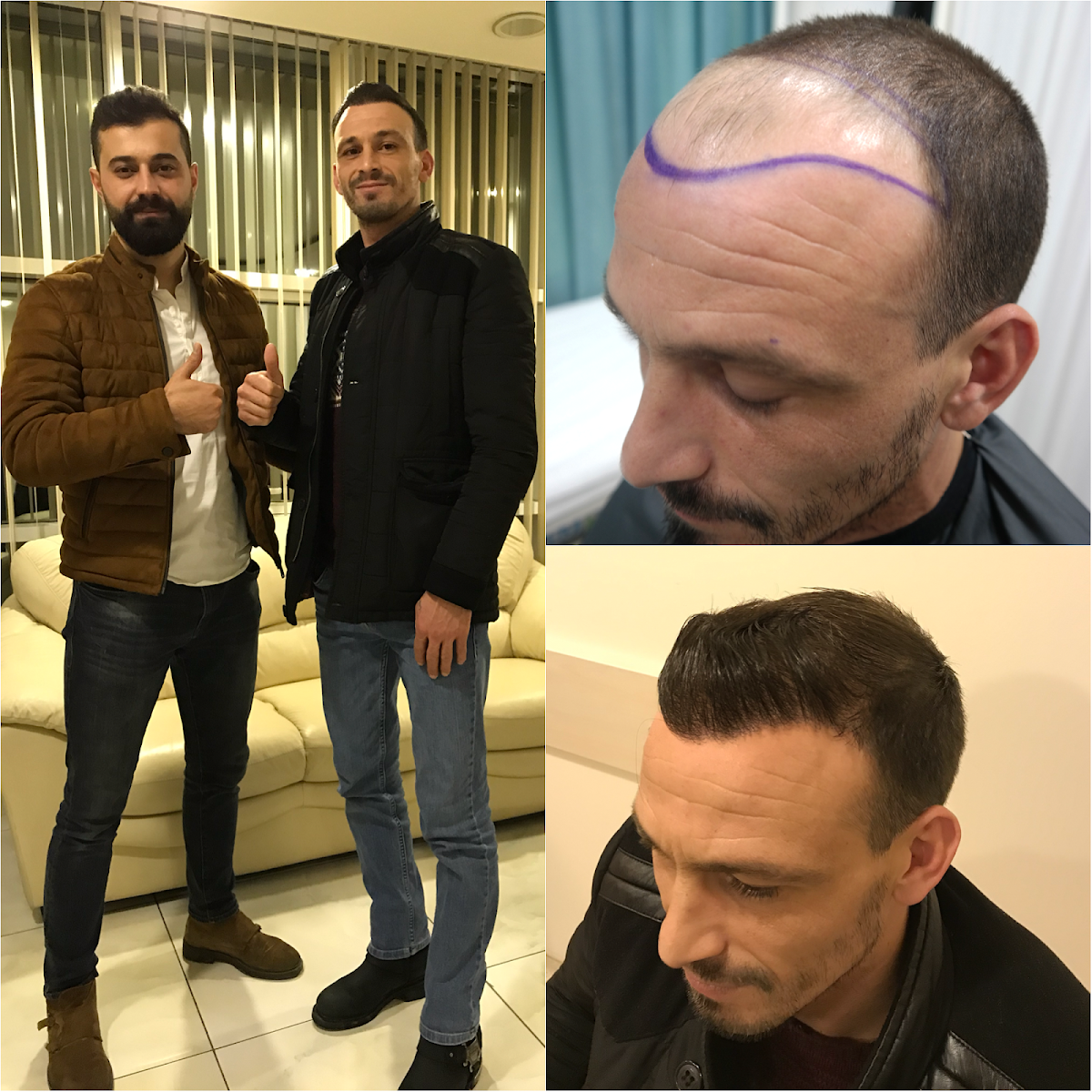 Estetichaircenter Saç Ekimi Saç Simülasyonu Bursa — Dr.Visor photo 4