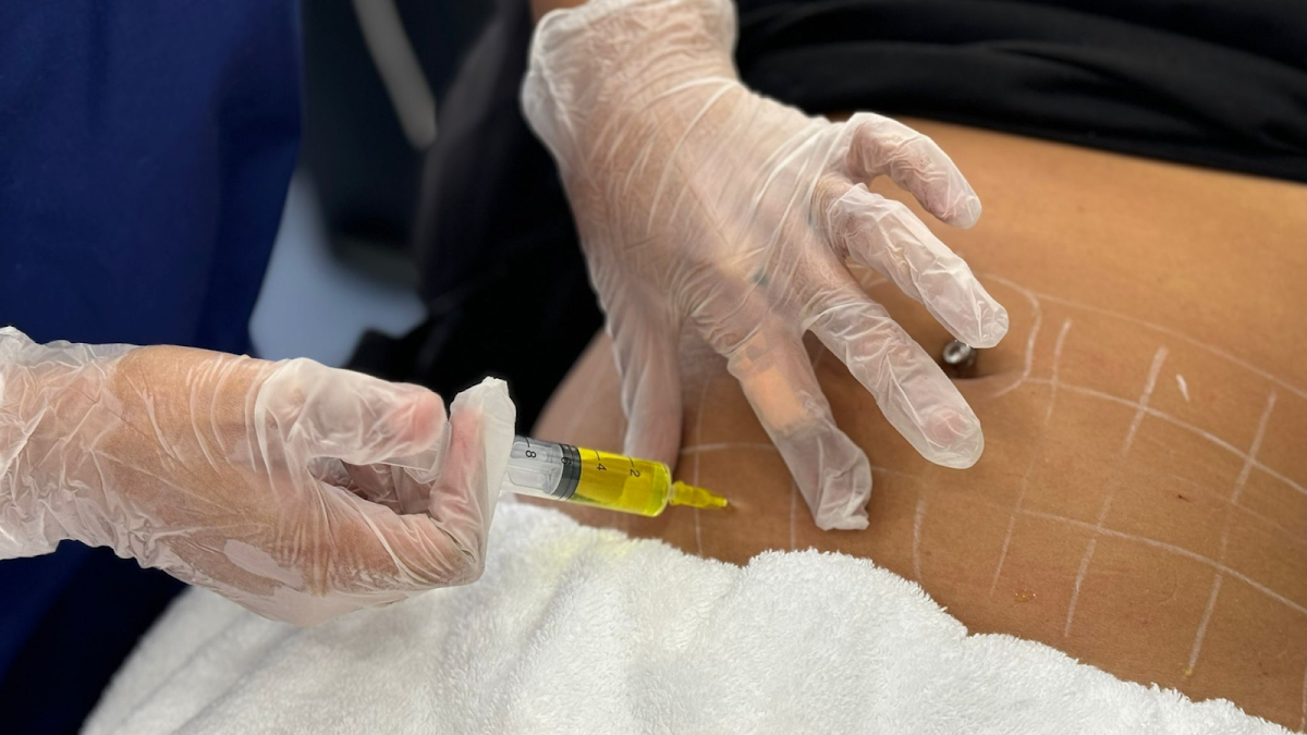 Fat Freezing and Facelift Belfast — photo 3