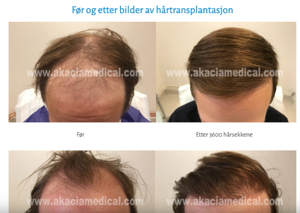 Akacia Medical Norge | Hair Transplant | 1712 Grålum