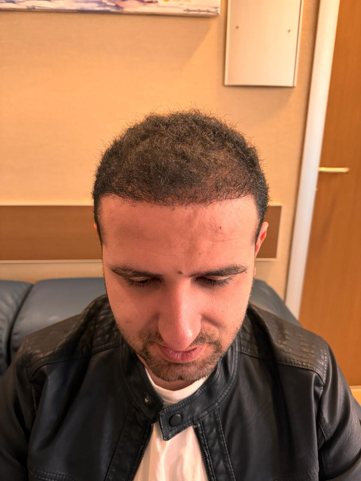 Bilyana Hair Transplant — Dr.Visor photo 3