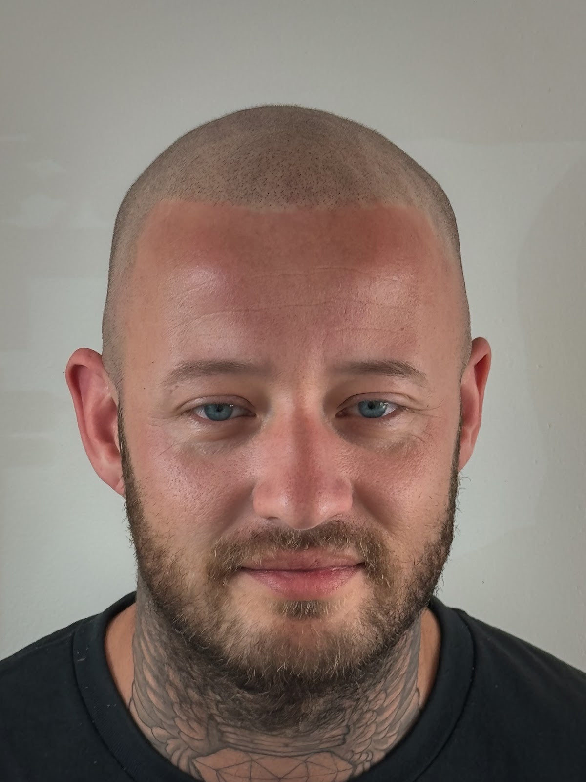 Prince Micro | Hair Transplant | Lexington, KY