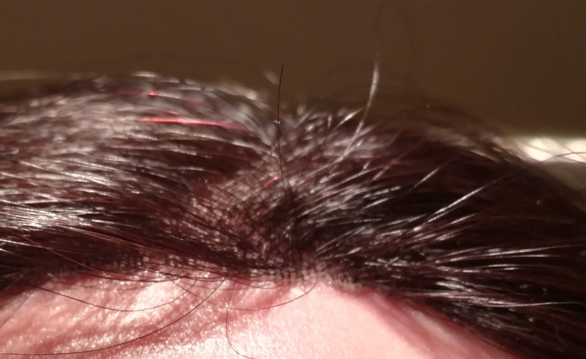 HRS of  Inc | Hair Transplant | Tualatin, OR