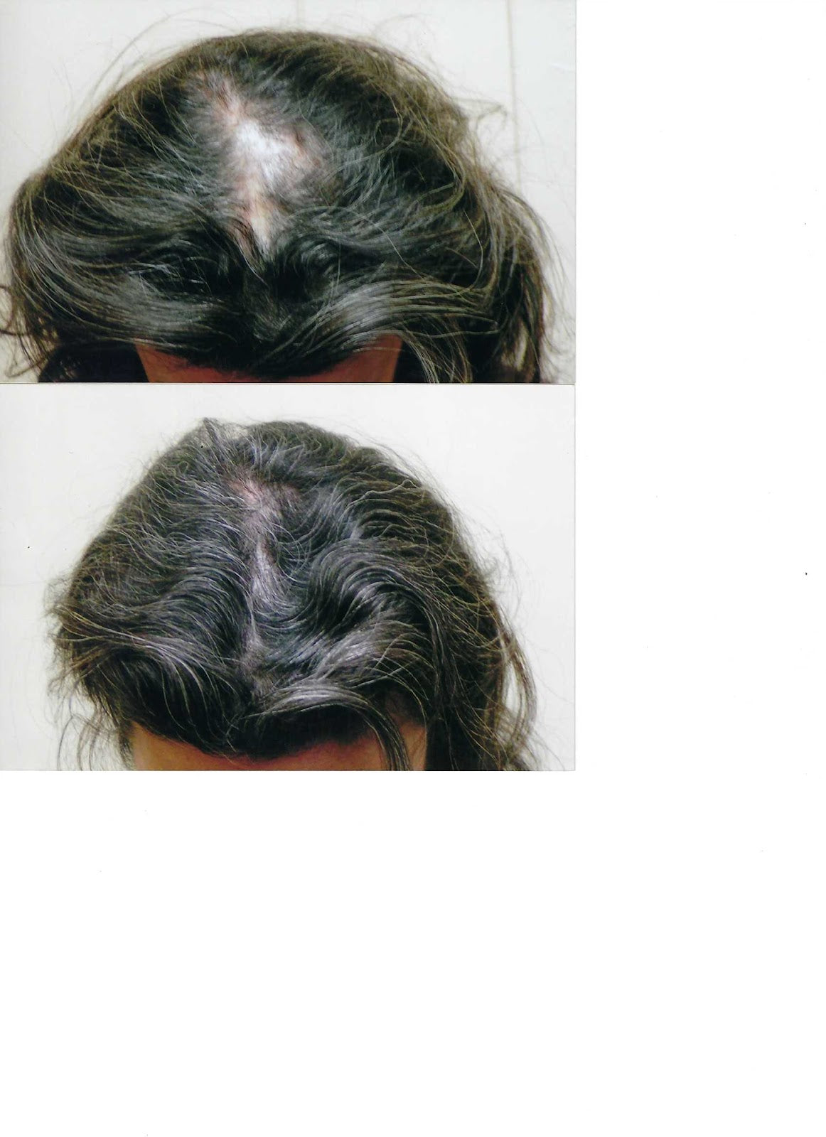 Regenerative Aesthetics | Hair Transplant | Edmond, OK
