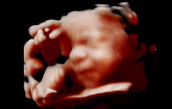 Unique Peek HD | IVF | Minot, ND