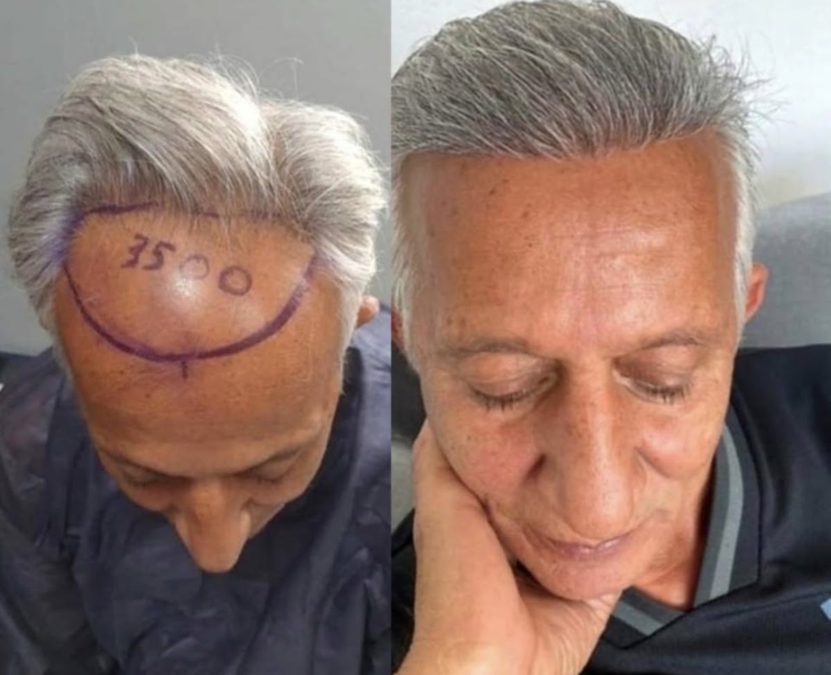 Best hair transplant clinic Manchester — photo 2