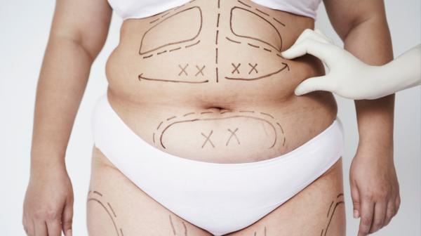 New Life Medical | Bariatric Surgery | Norwalk, CT