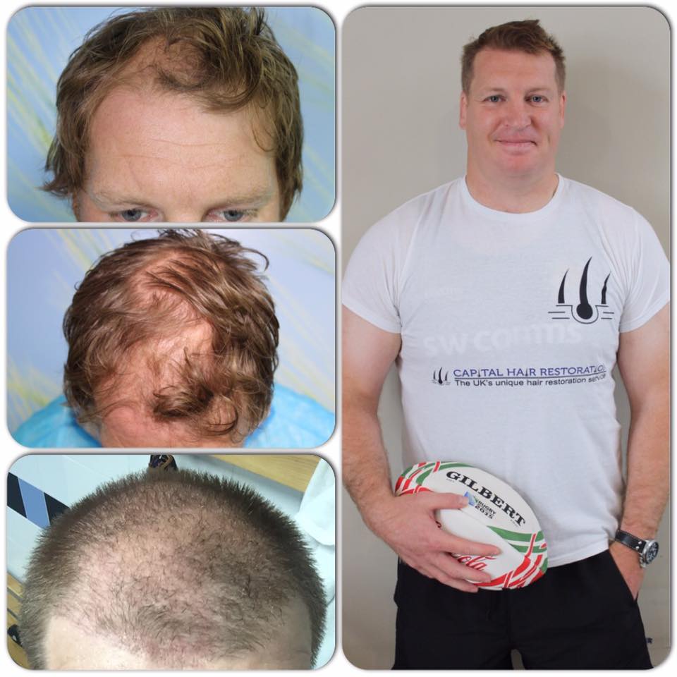 Capital Hair Restoration - Hair Transplant — photo 2