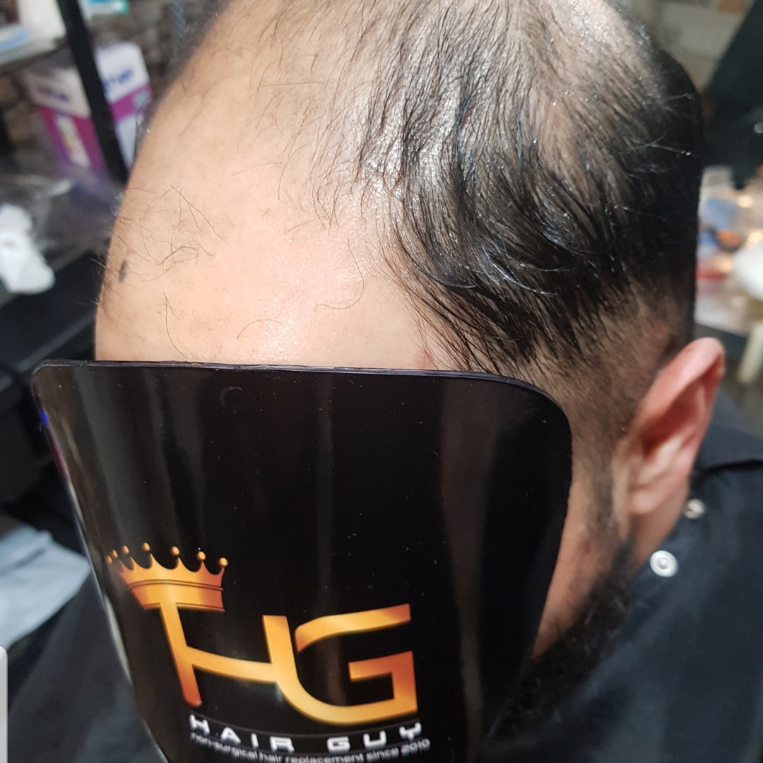 Mens Hair System - Hair Transplant clinic in Bradford, United Kingdom