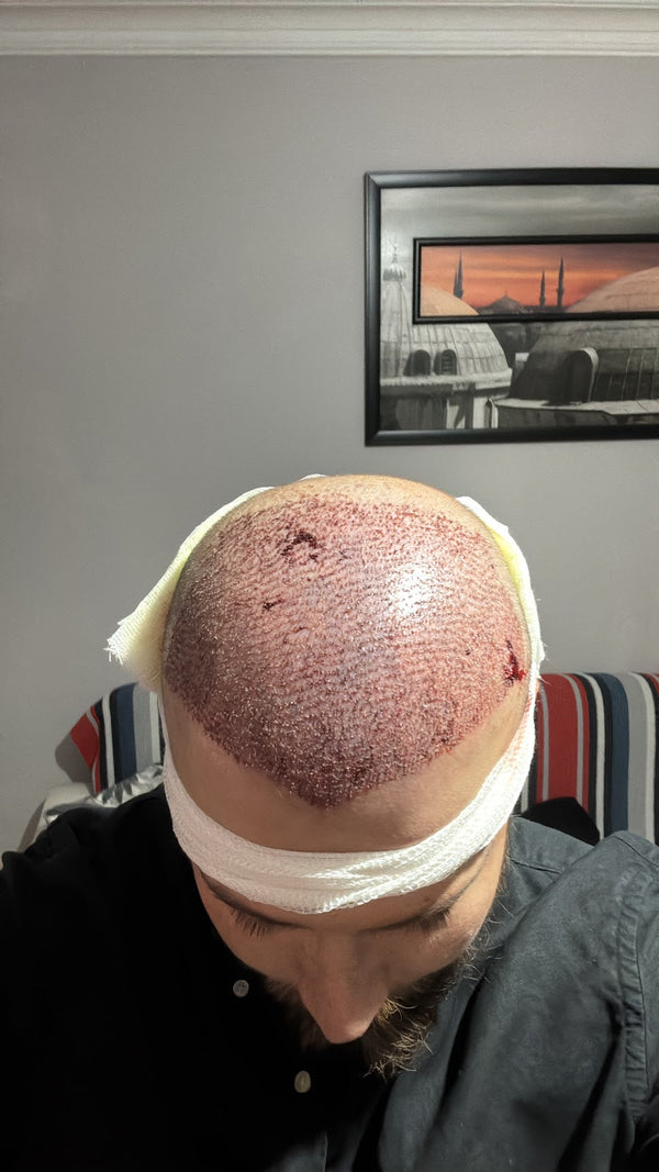 Ahmet Arslan Hair Transplant | Ankara Saç Ekimi PRP