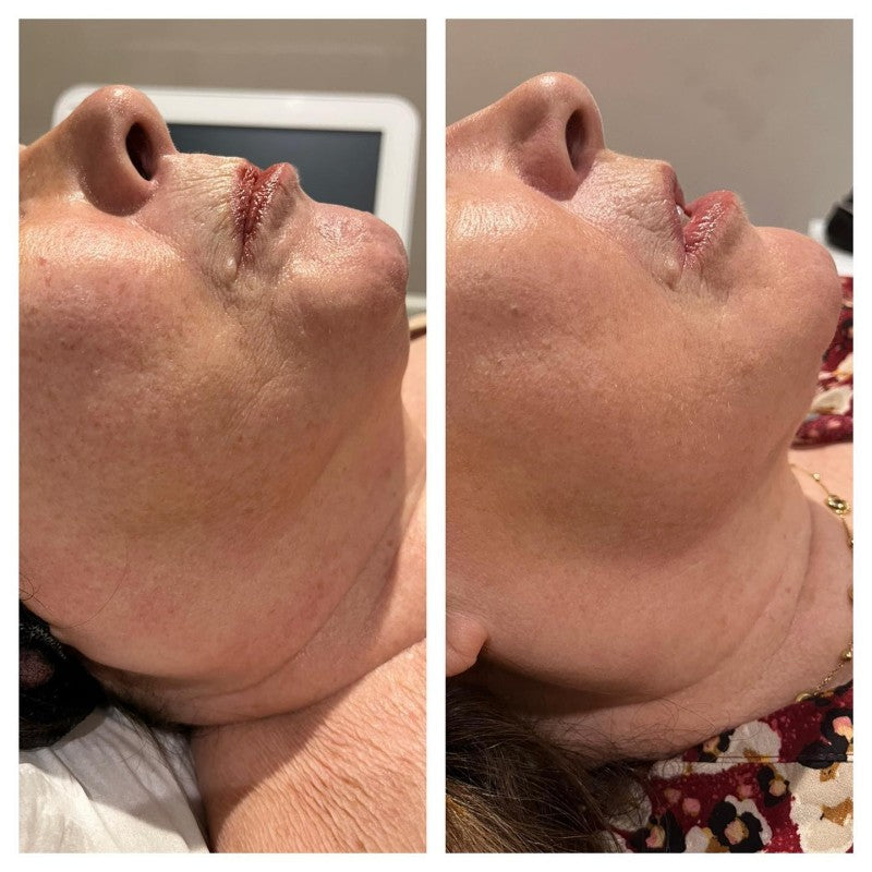 HIFU Facelift Clinic Leeds — photo 4