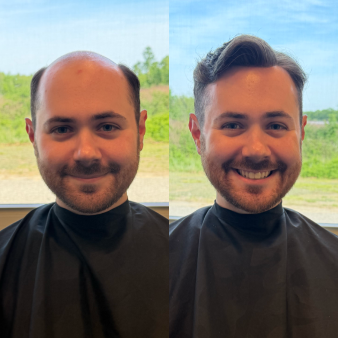 Madeline's Hair Replacement | Hair Transplant | Saco, ME