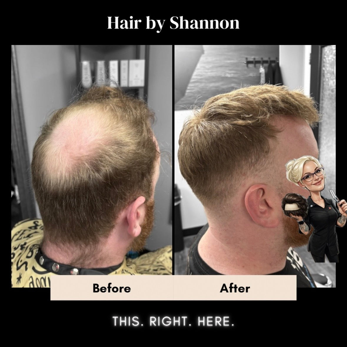 Hair by Shannon | Hair Replacement Specialist | Hair Transplant | Louisville, KY