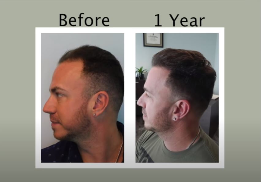 Great Hair Transplants | Hair Transplant | Fort Lauderdale, MO