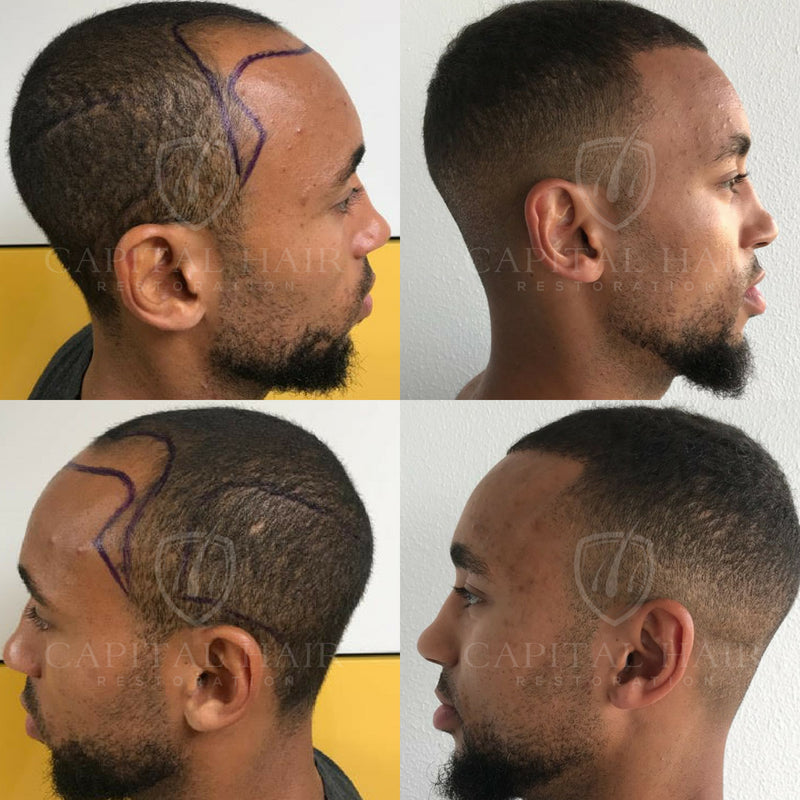 Capital Hair Restoration - Hair Transplant — photo 4