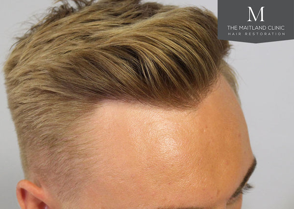 The Maitland Clinic | Hair Transplant | Portsmouth