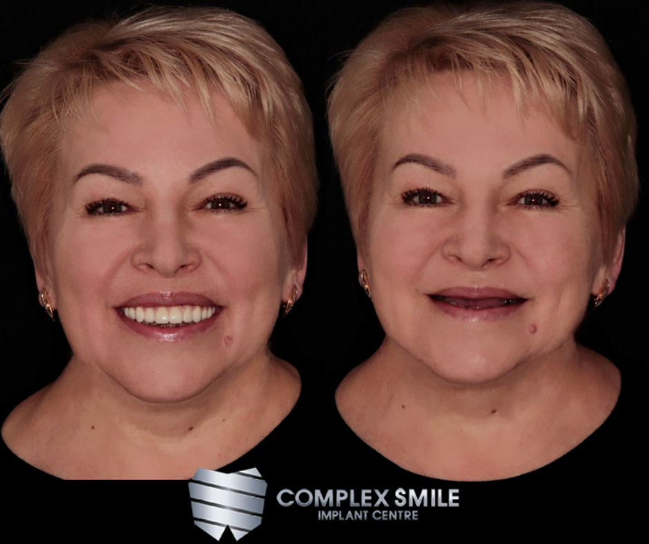 Complex Smile implant centre — Dental Clinic in London