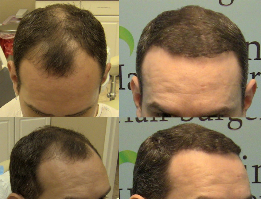 Carolina Hair Surgery | Hair Transplant | Fort Mill, SC