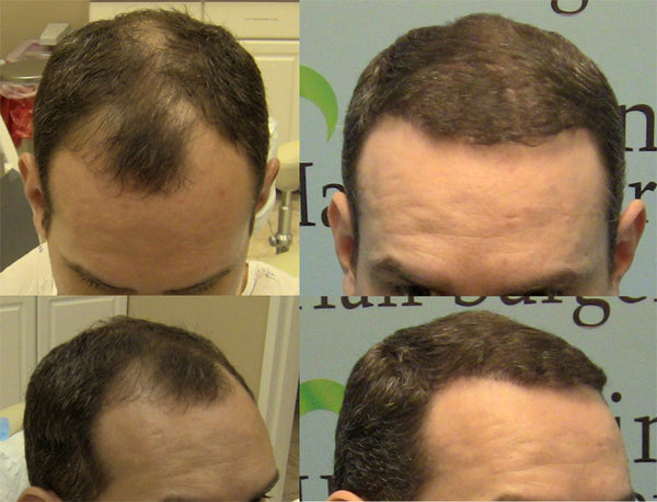 Carolina Hair Surgery | Hair Transplant | Fort Mill, SC