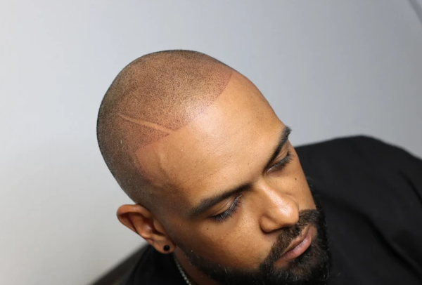 Santoyo SMP | Scalp Micropigmentation | Hair Transplant | Las Vegas, NV