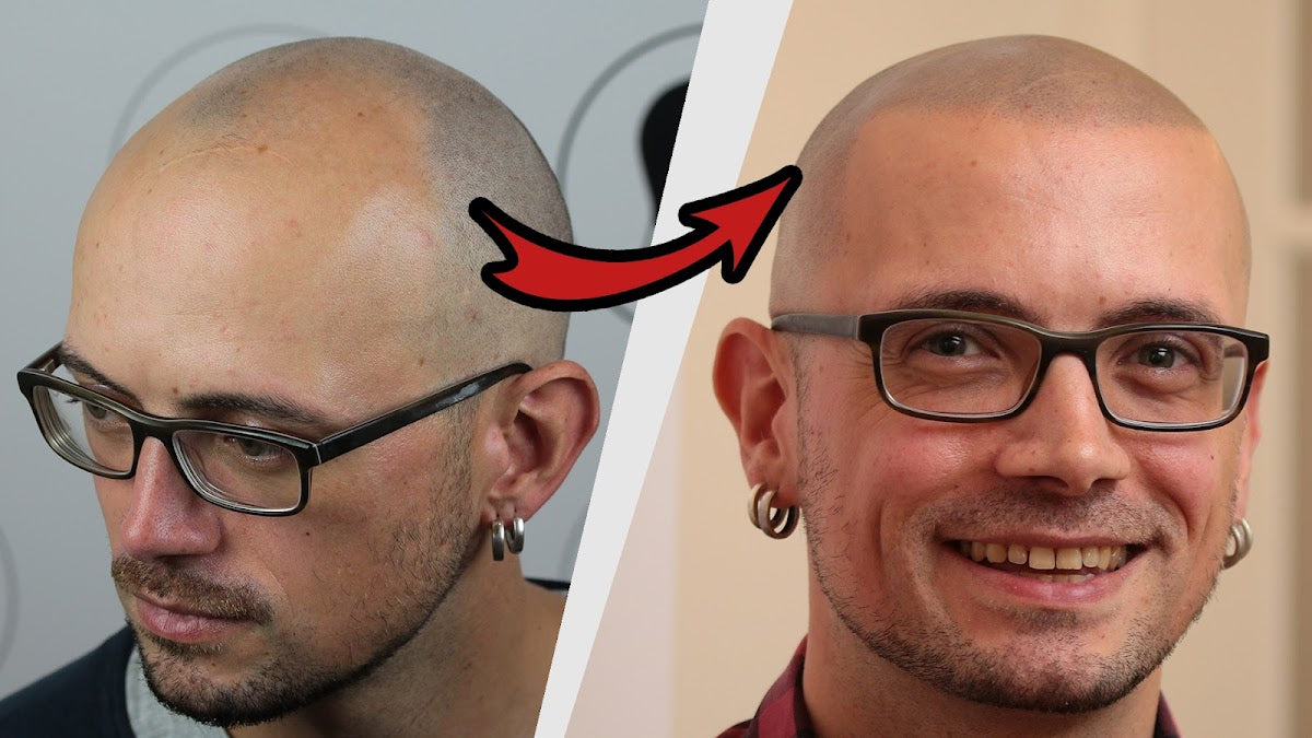 Haarpigmentierung | Modern Hair Loss Solution - Hair Transplant clinic in Berlin, Germany