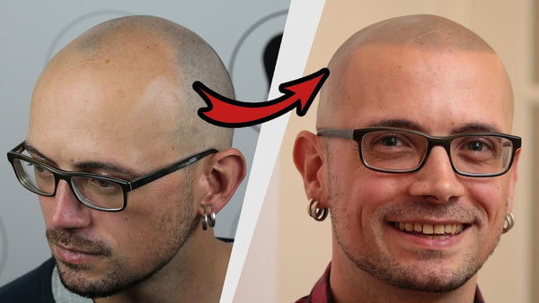 Haarpigmentierung | Modern Hair Loss Solution | Hair Transplant | Berlin