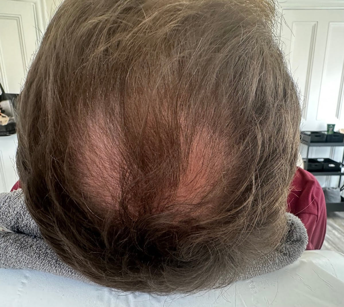 Vita Clinic Liverpool - Hair Transplant clinic in Liverpool, United Kingdom