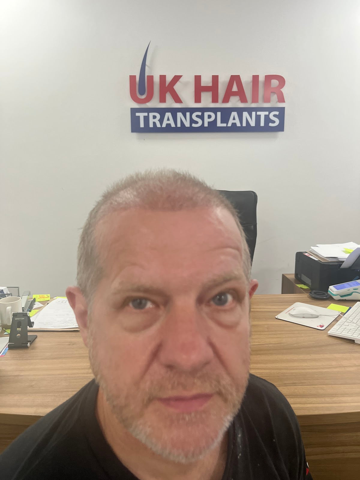 UK Hair Transplants UKHT Walsall — photo 3