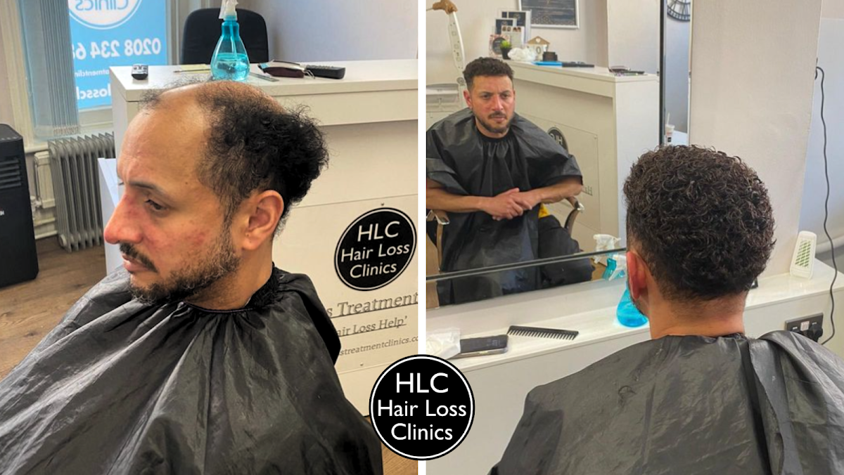 Stoke on Trent Hair Loss Clinic — photo 5