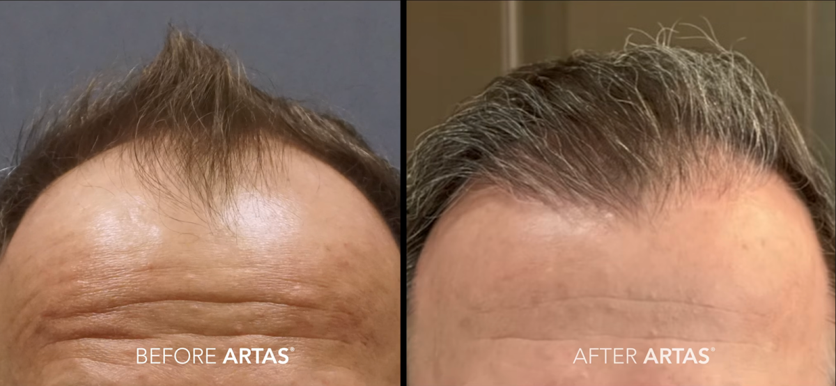 Pacific Northwest Hair Restoration | Hair Transplant | Tigard, OR