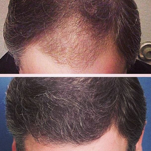 Advanced Medical Hair Institute | Hair Transplant | Reno, NV