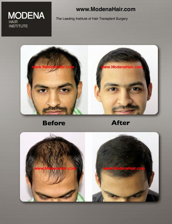 Modena Hair Transplant Institute | Hair Transplant | Henderson, NV