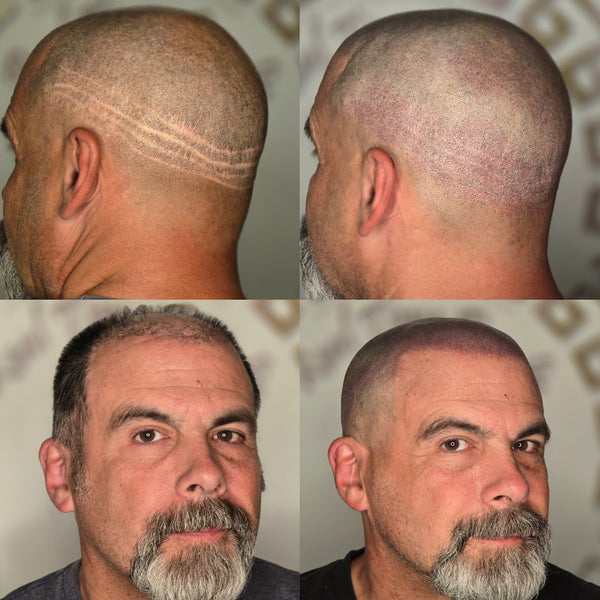 Real Time Results - SMP Services | Hair Transplant | Boise, ID