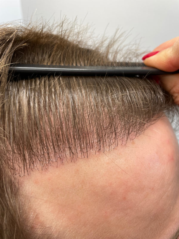 Unique Hair Hamburg | Haartransplantation | PRP Behandlung | Hair Transplant | Hamburg