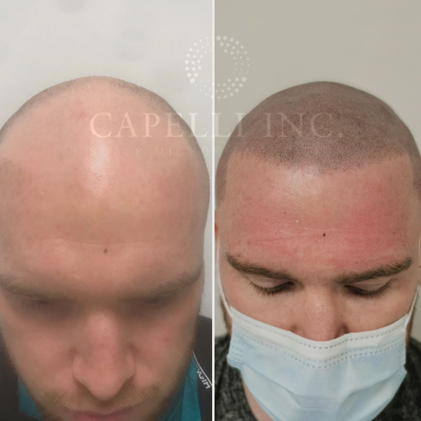 Capelli Inc | Hair Transplant | Liverpool