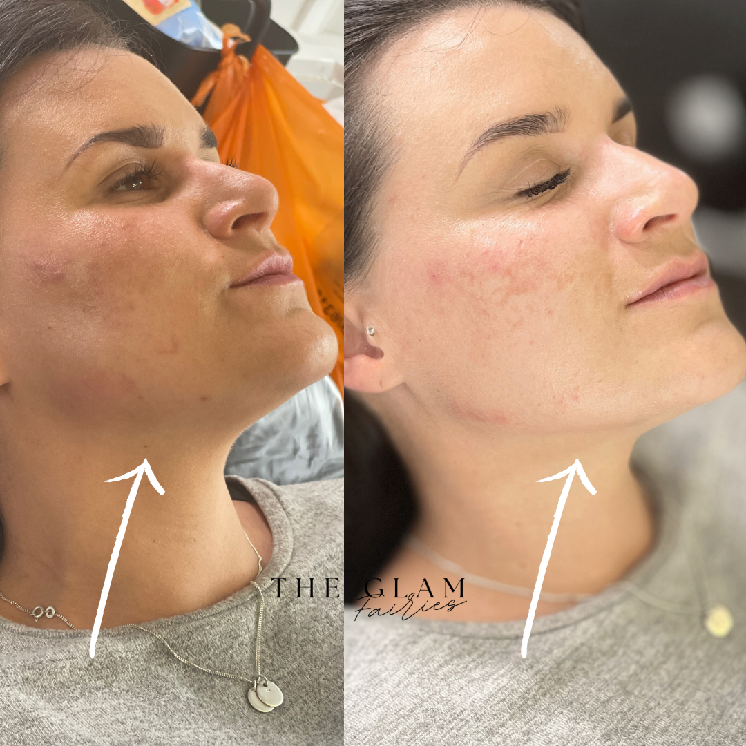 The Glam Fairies | Aesthetic Clinic | Microneedling Birmingham | PRP Birmingham | Chemical Peel Birmingham — photo 4