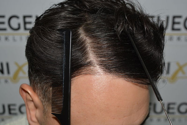 FueGenix Haarkliniek | Haartransplantatie in Nederland | Hair Transplant | Netherlands