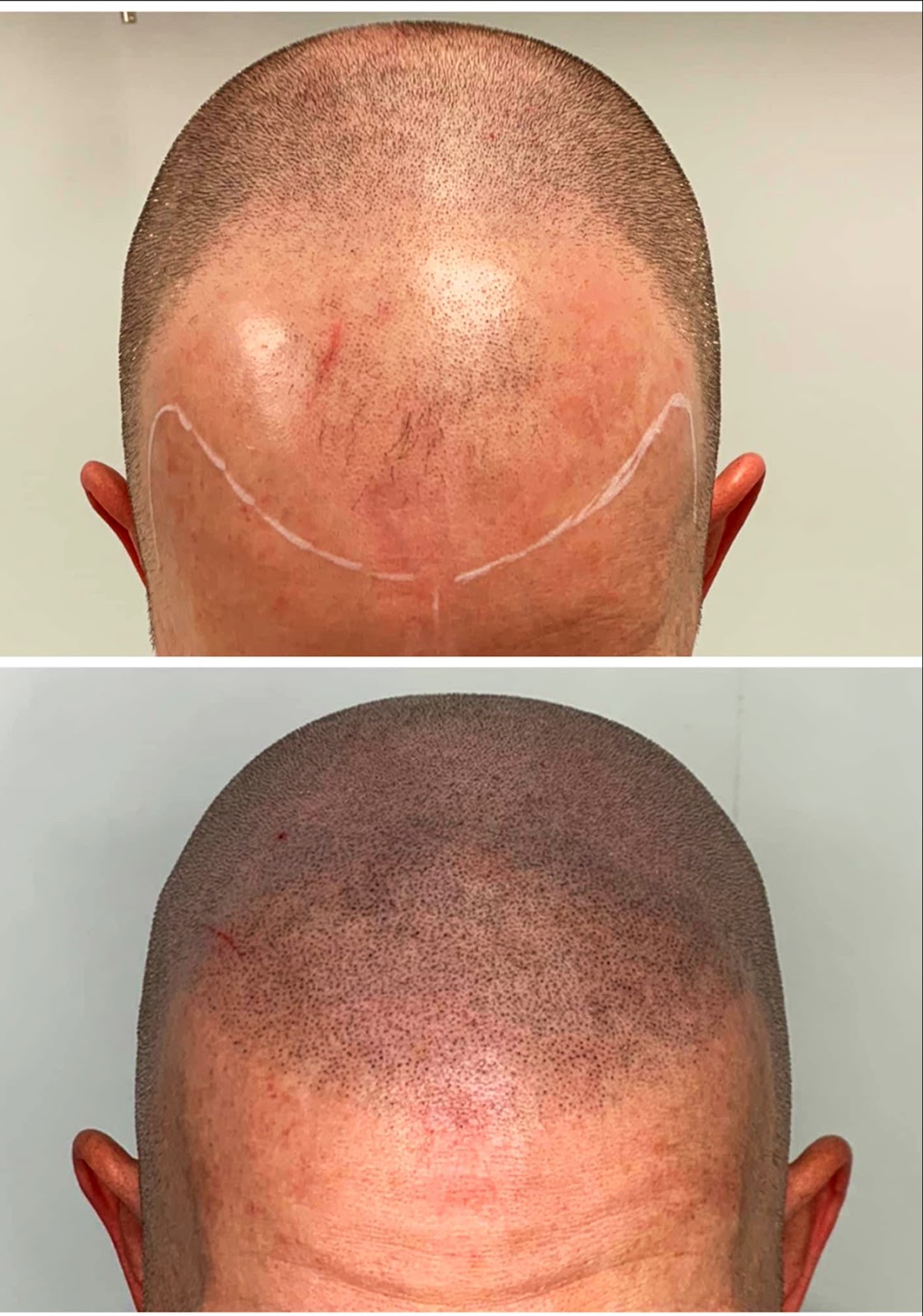 Natural Scalp - Hair Transplant clinic in Cardiff, United Kingdom