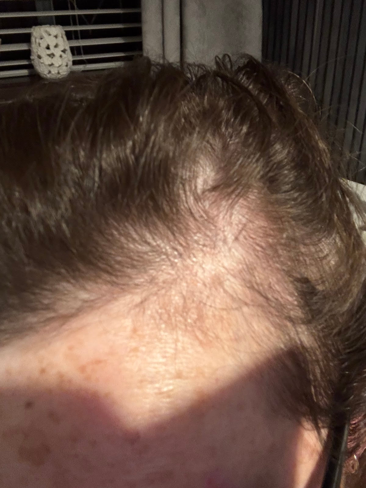 Renova Hair Trichology — Hair Transplant Clinic in Leeds