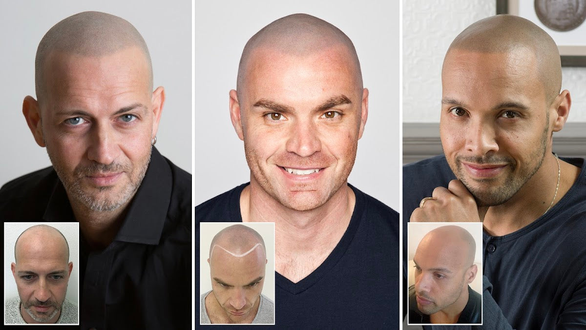 Skalp | Manchester Scalp Micropigmentation Clinic — Hair Transplant Clinic in Manchester