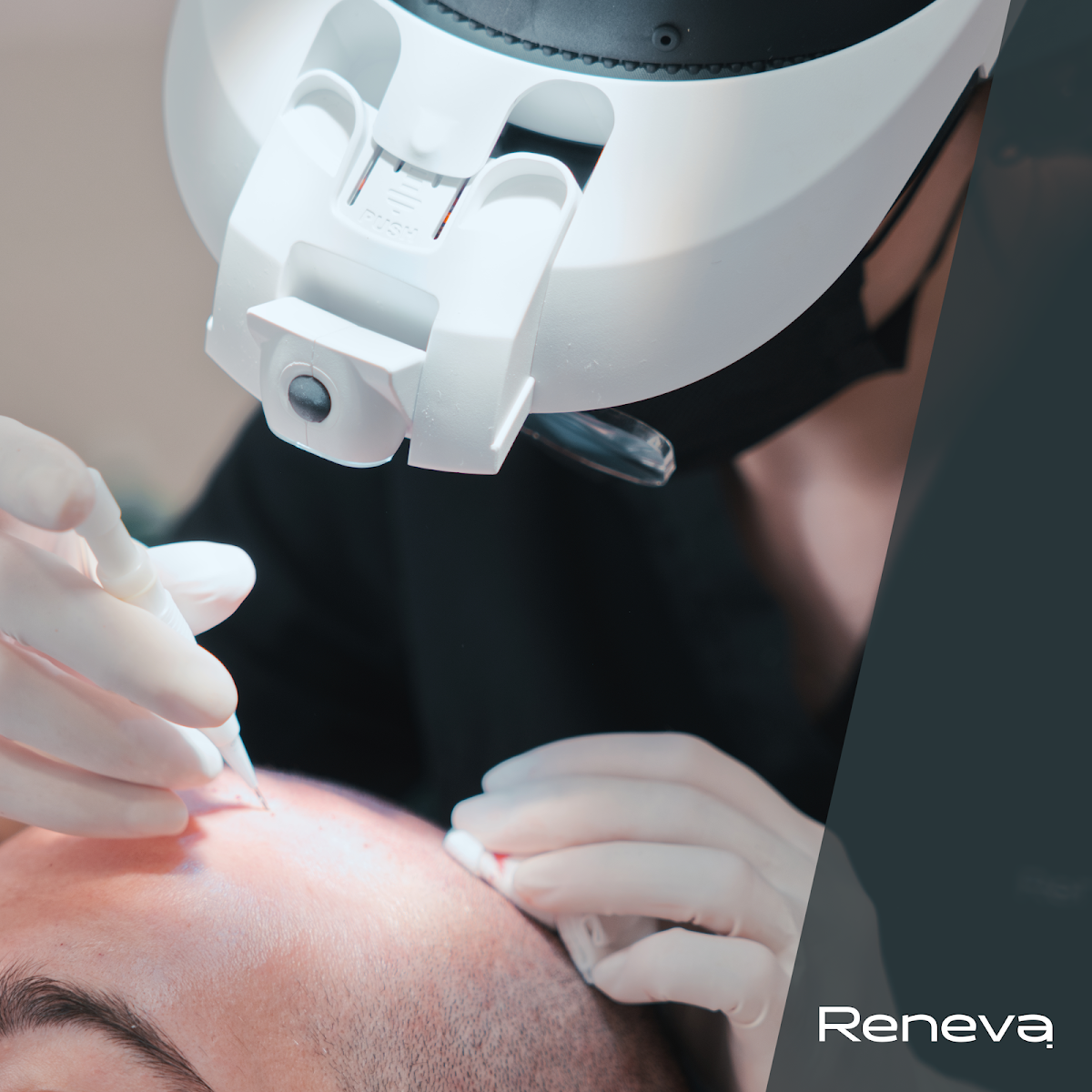 Reneva Hajbeültetés és Esztétikai Klinika - Hair Transplant clinic in Zugligeti út 60, Hungary
