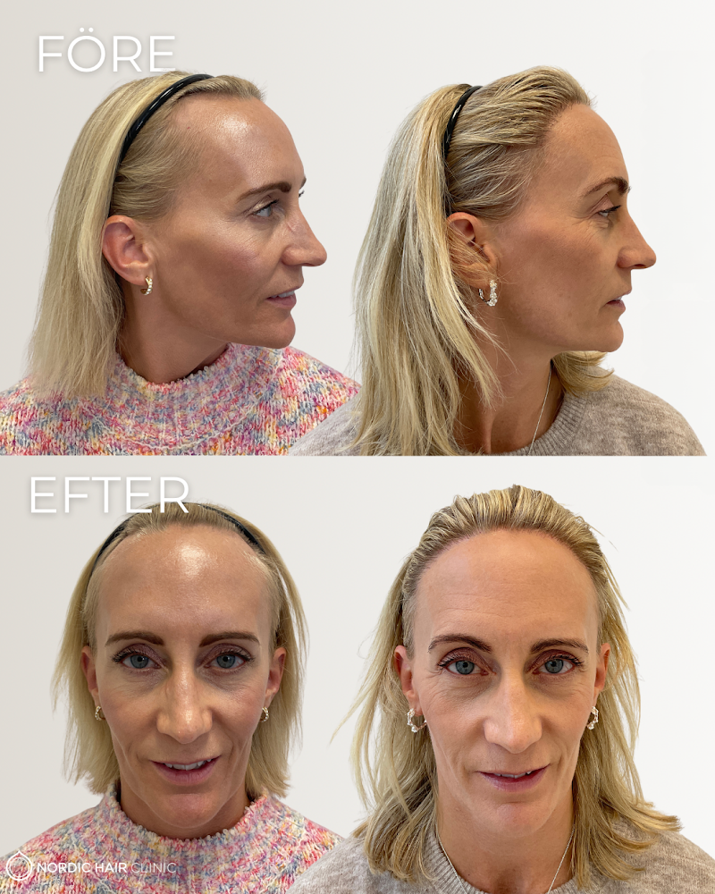 Nordic Hair Clinic Stockholm | Hair Transplant | 112 27 Stockholm