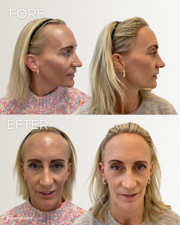 Nordic Hair Clinic Stockholm | Hair Transplant | 112 27 Stockholm